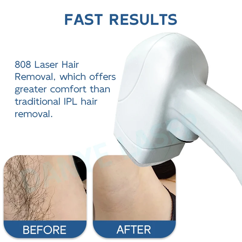 portable 808 diode laser hair removal machine price 755 808 1064nm diode laser hair removal machine
