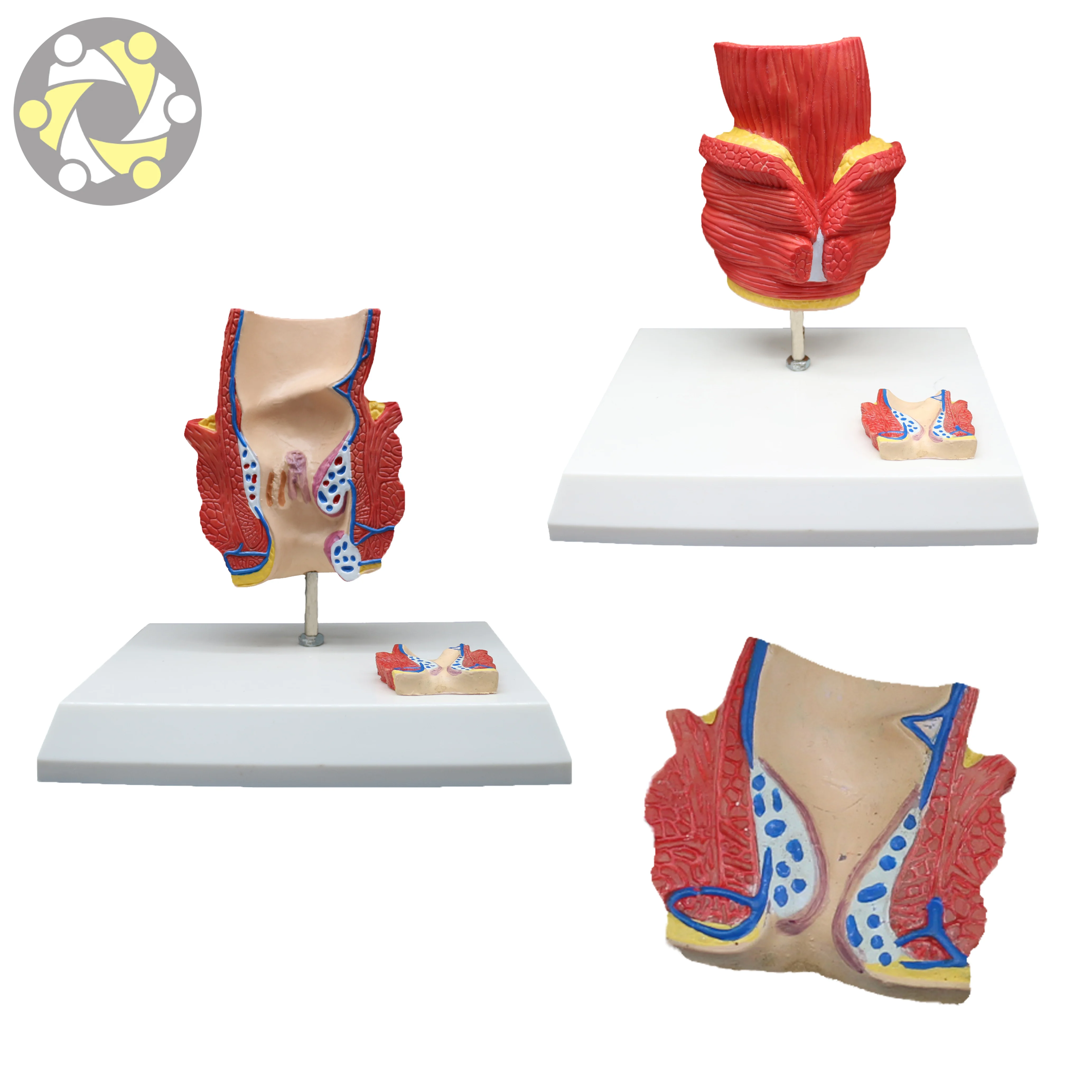 Medical Science Model of Hemorrhoids Anal Rectal Disease Haemorrhoids Human Anatomy Model