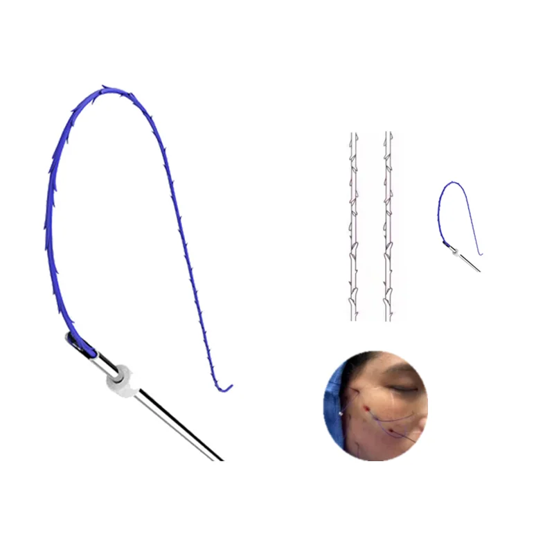 China Manufacturer bottock breast face lifting Cog 4D 21G 100mm PDO&PCL Cog thread