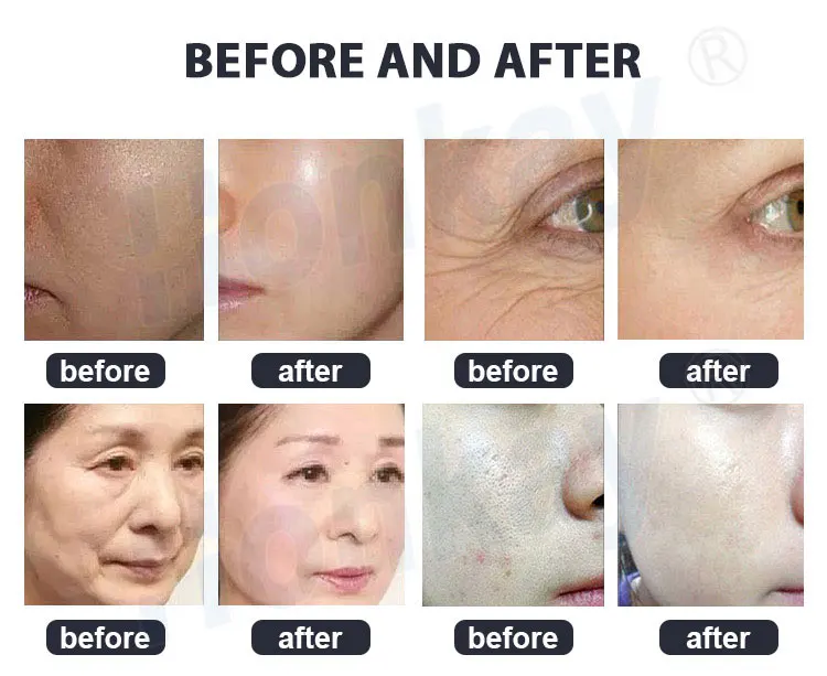 hydro water facial oxygen hydrogen water generator 8 in 1 jet peel hydradermabrasion diamond micro dermabrasion for sale