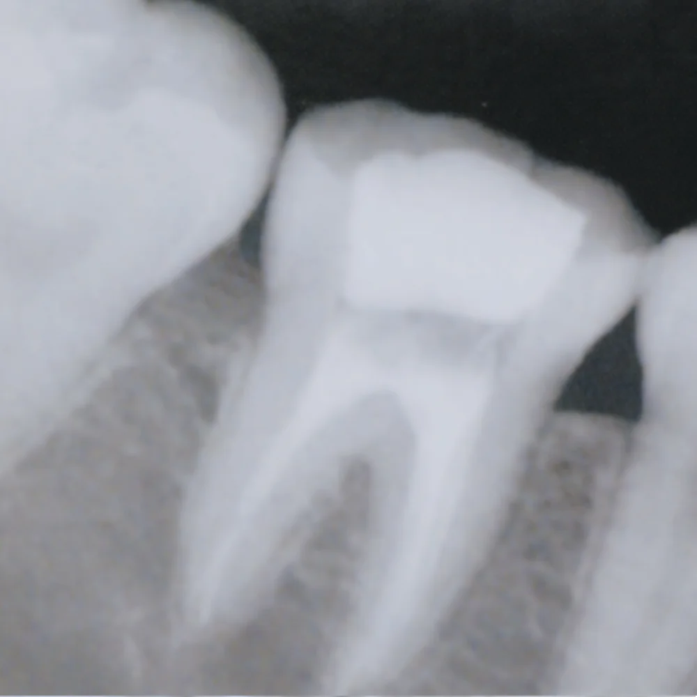 Portable Dental Equipments Remote Control Wall Mounted Panoramic X-Ray Unit Medical Dental X Ray Machine