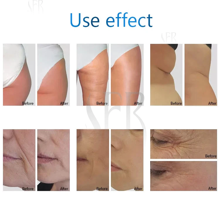 Hottest eye ems rf massager weight loss body shaping treatment celulite roller machine rf slimming machine for sale