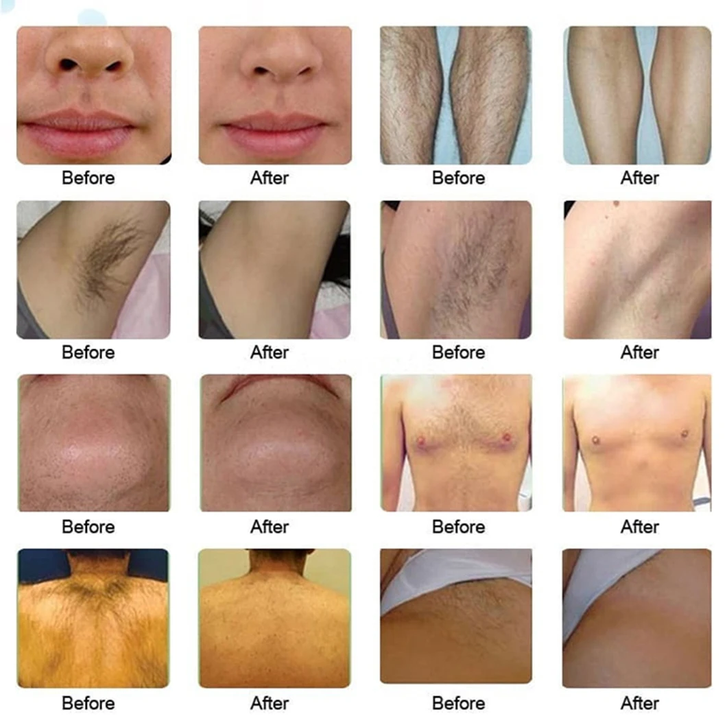 Best-selling-808nm-1064nm-diode-laser-hair-removal-machine-painless-spots-treatment-machine-K16-808