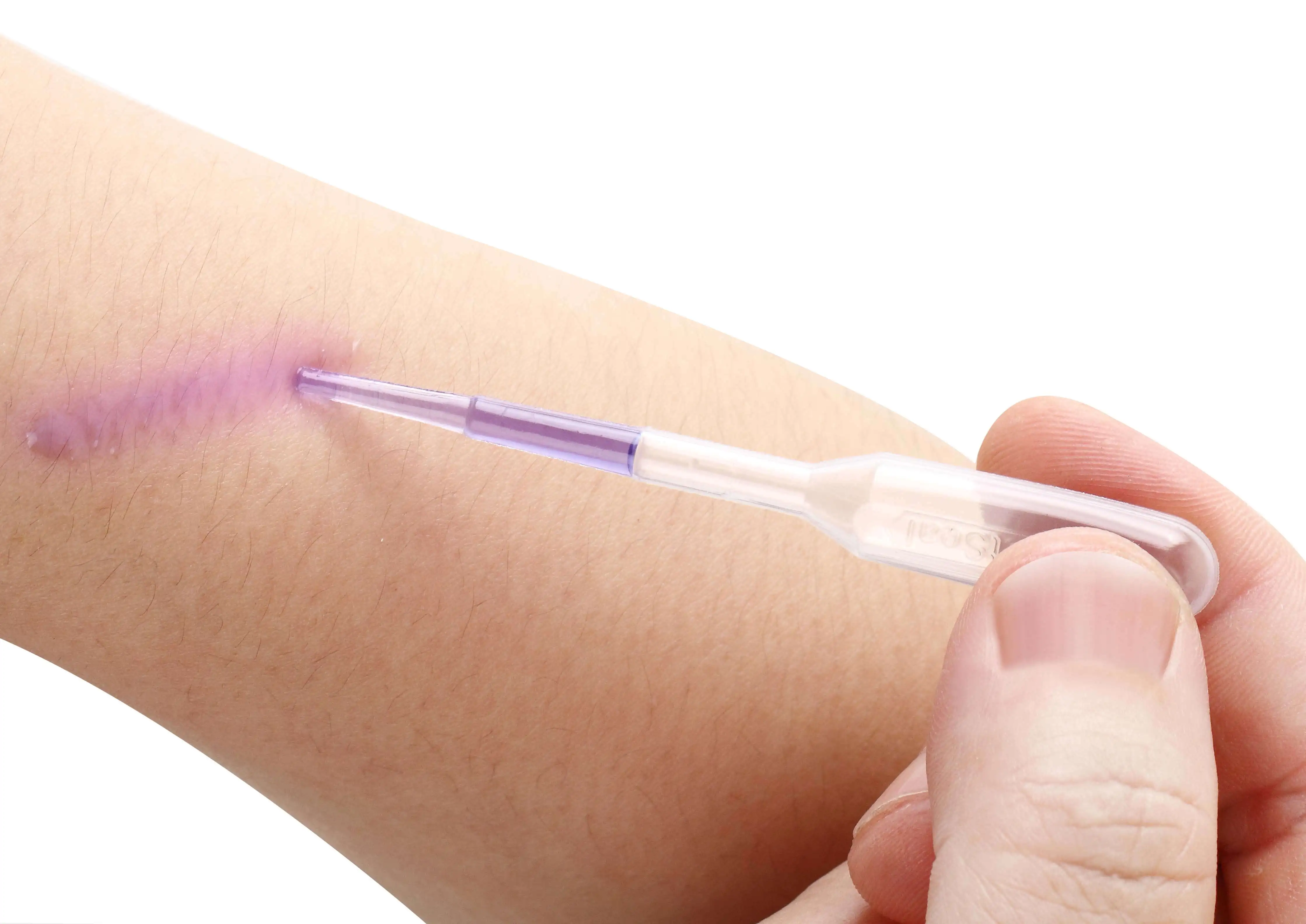 Best skin glue surgical tissue adhesive for wound closure