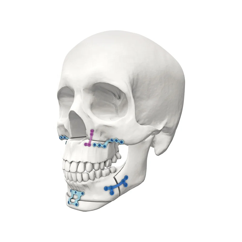 Maxilloficial Orthognathic Medical Implant Genioplasty Titanium Plates 5 Holes(0.8mm)