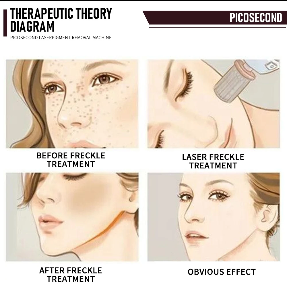 New Arrival HUAMEI Professional Skin Whitening Laser Picosecond/Laser Pico Laser Tattoo Removal Machine 1064nm 532nm 1320nm