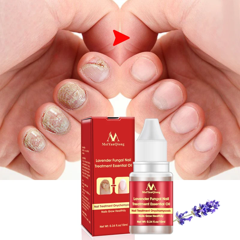 Fungal Nail Treatment Feet Care Essence Removal Fungus Healthy Repair Serum Anti Infection Paronychia Onychomycosis