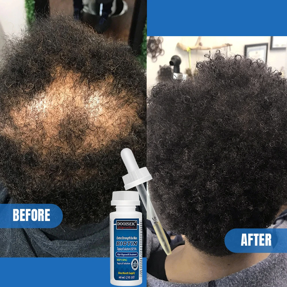 Most Popular 60ml Anti Hair Loss kirland hair growth oil treatment ginger essence 5% Hair Regrowth Treatment Serum