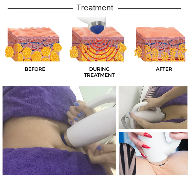 New Design Shockwave Non-invasion Anti-cellulite Muscle Relaxing Body Therapy Massage Equipment for Pain Relief Treatment