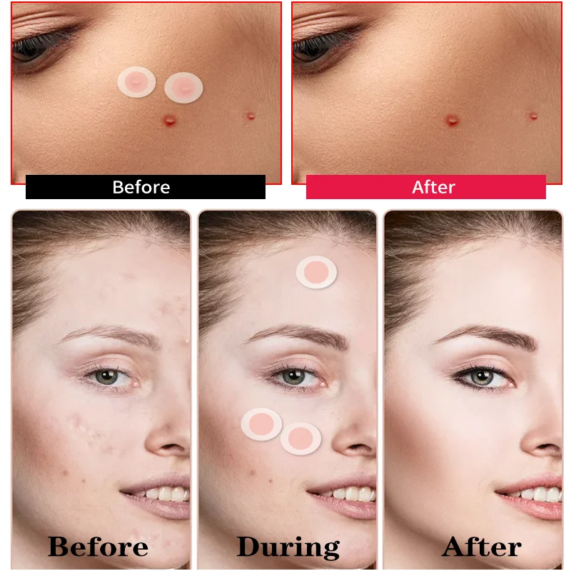 Private Label Rapairing Tea Tree Micro Needle Acne Patch Skincare Acne Treatment Spot Blemish Remover Patches Acne Patch