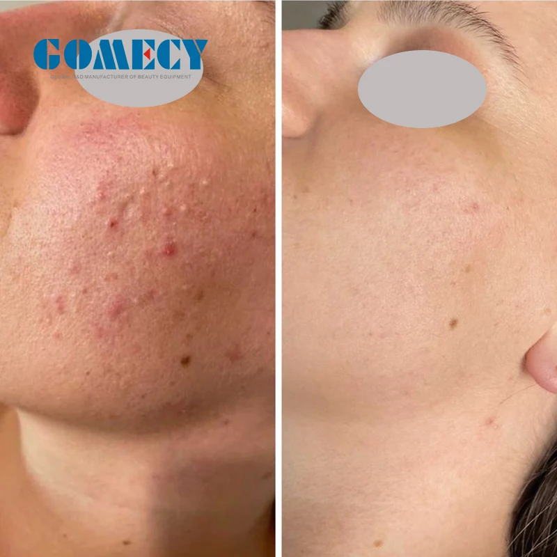 Fractional rf micronee face lifting beauty machine GOMECY 3 in 1 micro nee skin tightening morpheus 8