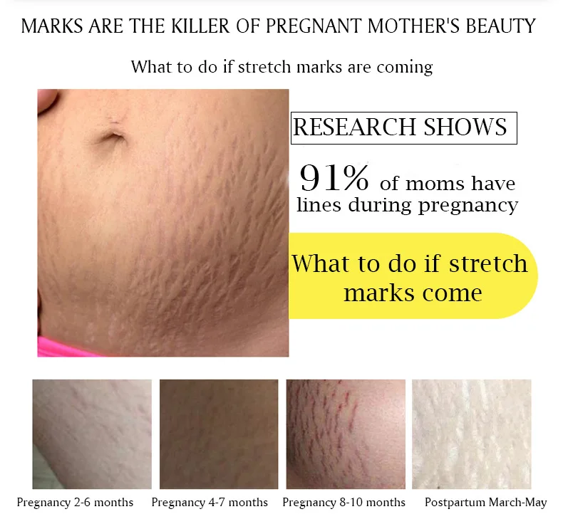 Wholesale Japan stretch mark removal skin care body