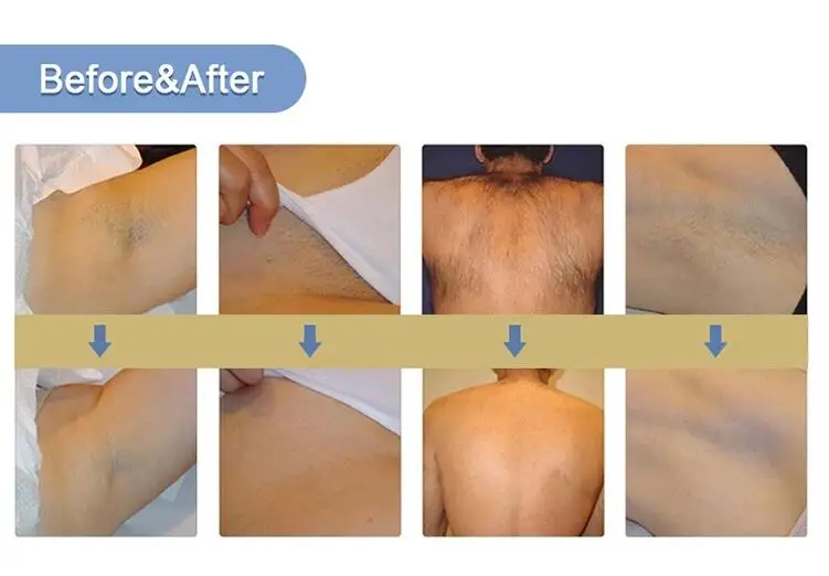 Tuv Medical Ce Certified Laser Diode 808nm Beauty Salon Equipment Device 2022 Alma 2000w Permanent 808nm Diode