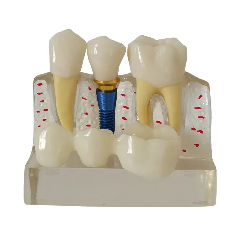 Transparent Repair Teeth Model Education Dental Implant Teeth  Dental Study Teeth Model