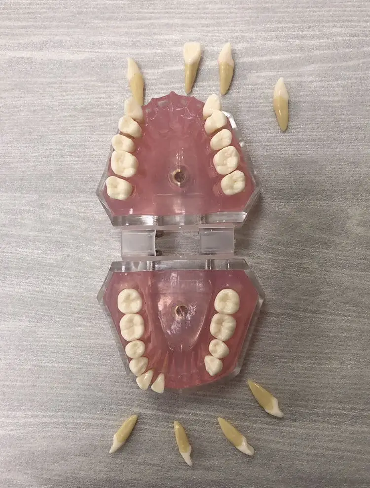 Dental Tooth Extraction Model with Soft Gum and Removable Teeth