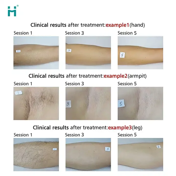 2 in 1 diode and picosecond laser picosecond q-switched laser tattoo removal machine diode laser hair remowal with picosecond