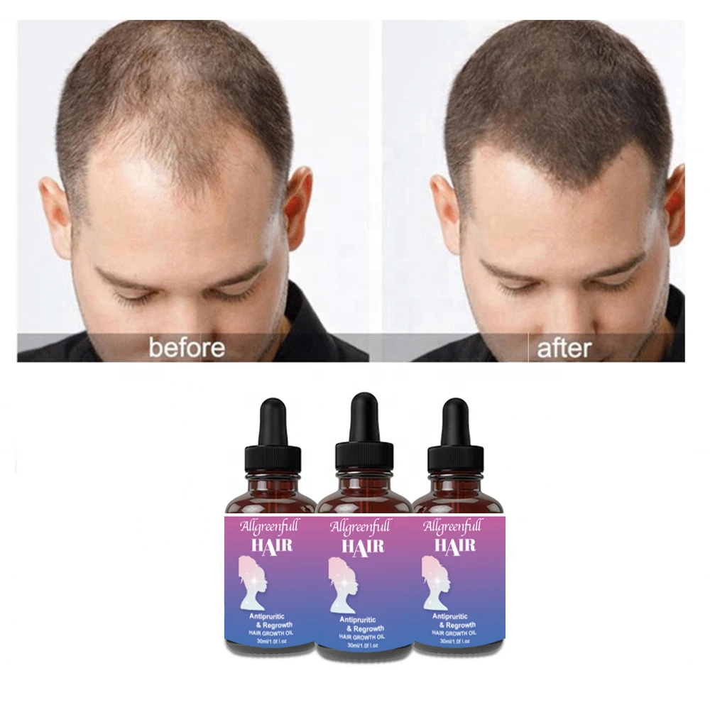 Free Sample Hair Scalp Treatment Promote Hair Growth oil Anti Hair Loss Anti Itching Oil