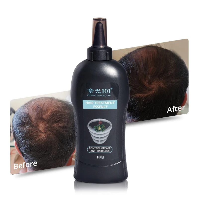 Top Rank Supplier Natural Alopecia Treatment Anti Hair Fall Oil