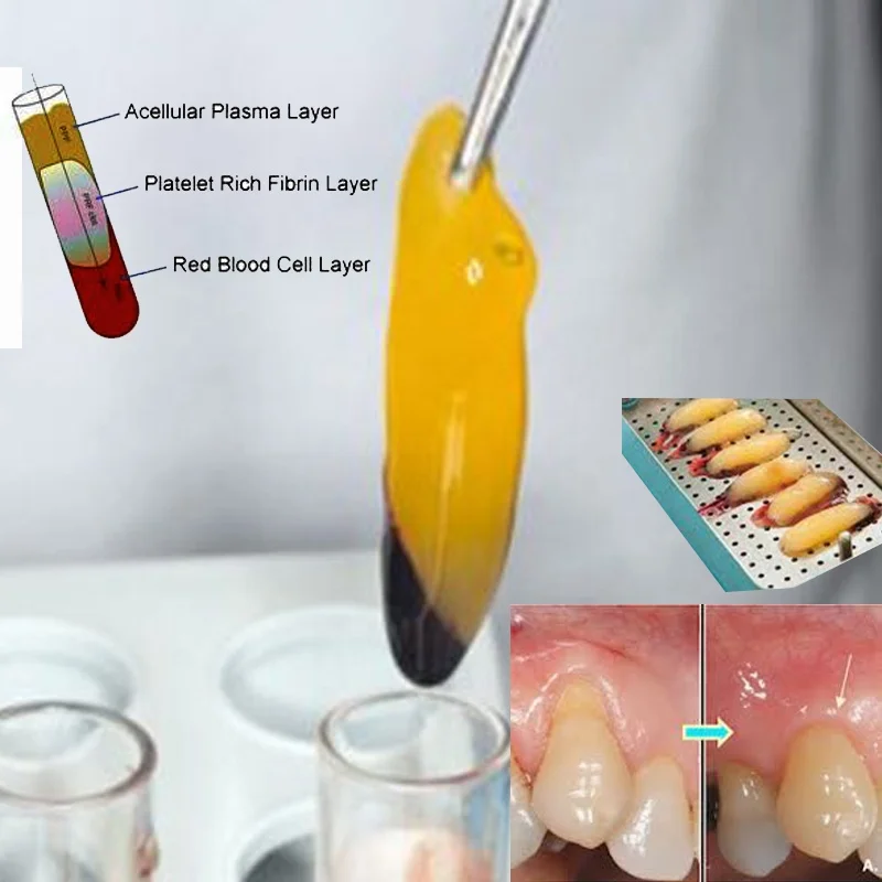 Tooth Implant Bone Graft Dental Supplies CGF PRF Tube