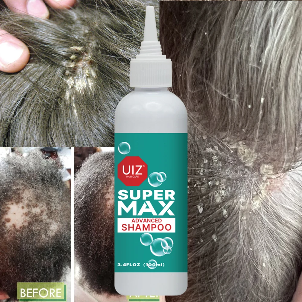 Lice Treatment shampoo, Kills Lice & Super Lice & Eggs Pesticide Free Anti Lice Shampoo
