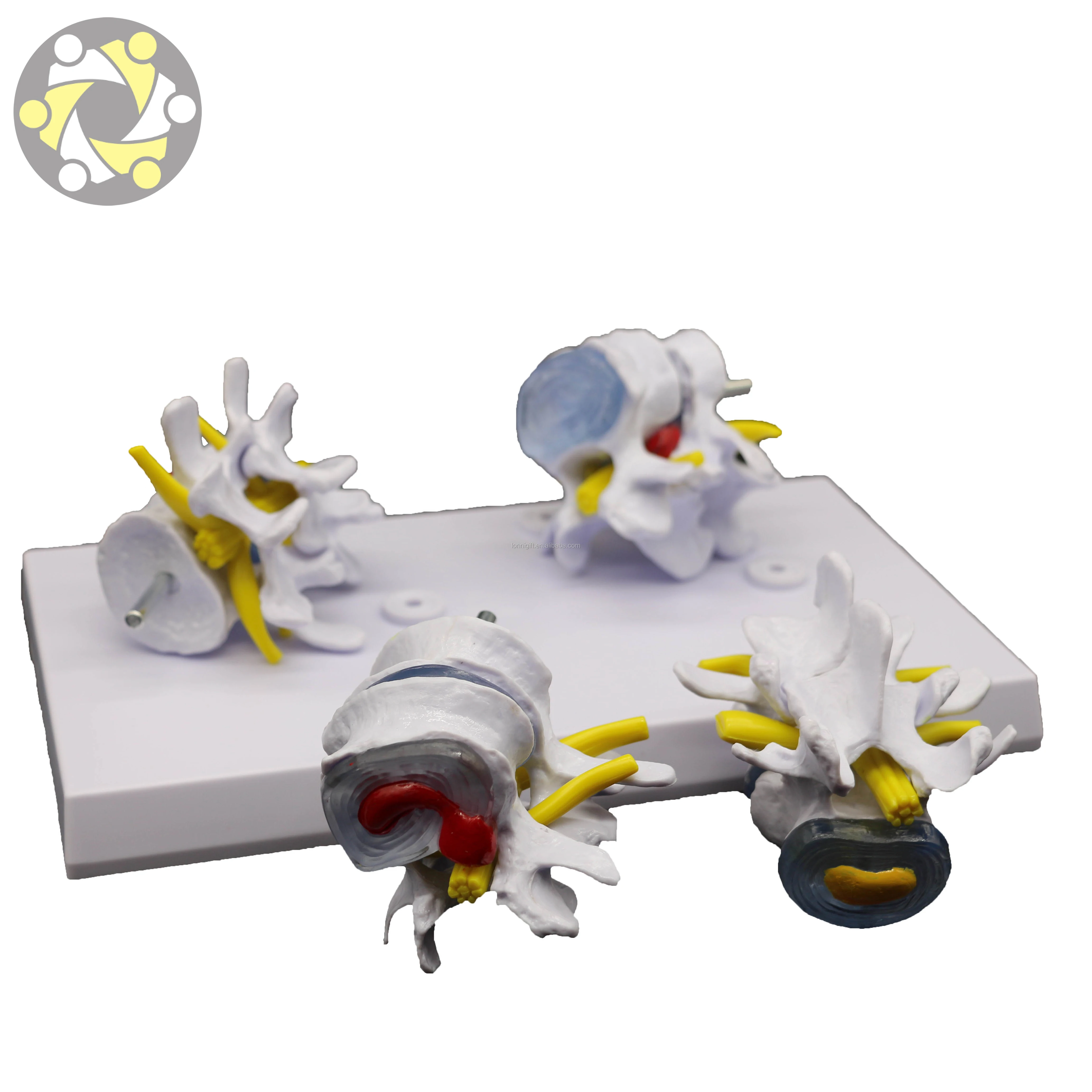 Medical Science 4 Stage Pathological Lumbar Skeleton Model