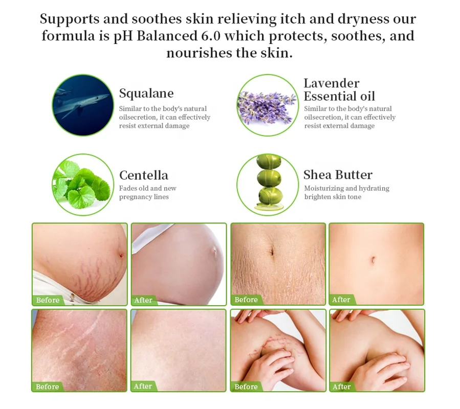  Private Label Stretchmark Remover Cream Natural Organic Body Scar Repair Slack Line Pregnancy Abdomen Anti Stretch Mark