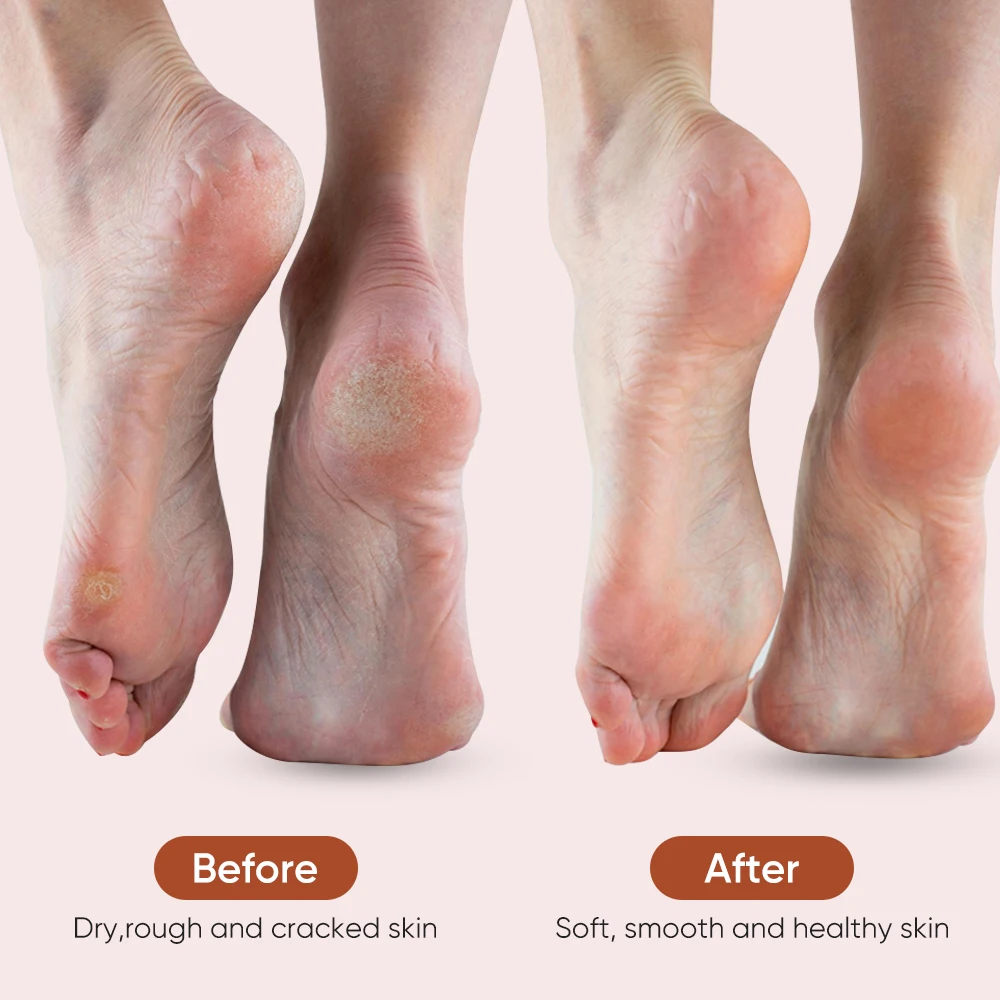 Foot Grinder Electric Foot Callus Remover with 3 Roller Heads Rechargeable Electric Callus Remover Tool