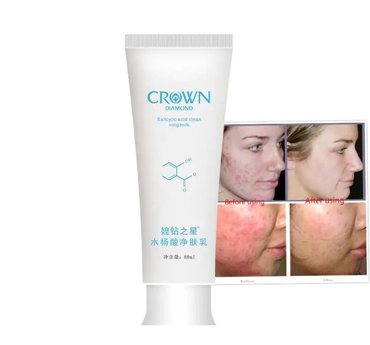 Herbal Treatment Skin Lotion Face Acne Scar Pimples Dark Spot Remover Salicylic Acid Tea Tree Oil Anti Acne Cream other beauty