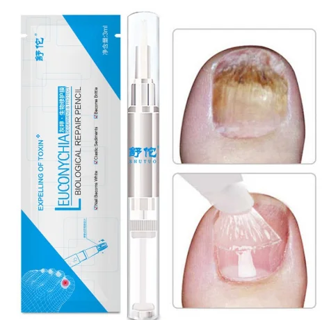 Nail Fungus Repair Treatment Pen Products Onychomycosis Paronychia Anti Fungal Nail Infection Chinese Herbal Care Oil Pen