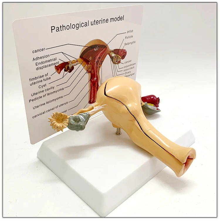 Standard price medical anatomical uterus teaching models of the uterine leiomyomas