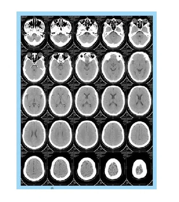 8x10 10x12 14x17 inch Medical dry X-ray Thermal film, blue PET polyester film for Agfa 5302 Fuji drypix 2000 3500 lite printers