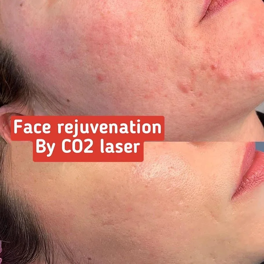 Портативная фракционная машина для удаления шрамов от