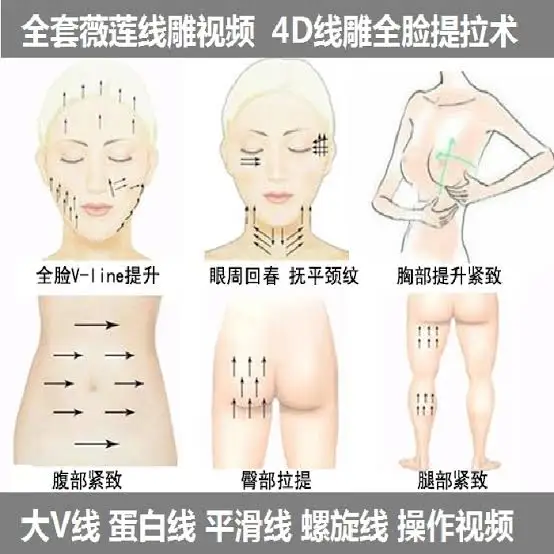 Best brand selling Secret Line PDO Thread Lift / Face Whole Body Lift chest and  butt Cog Type 21G*60mm