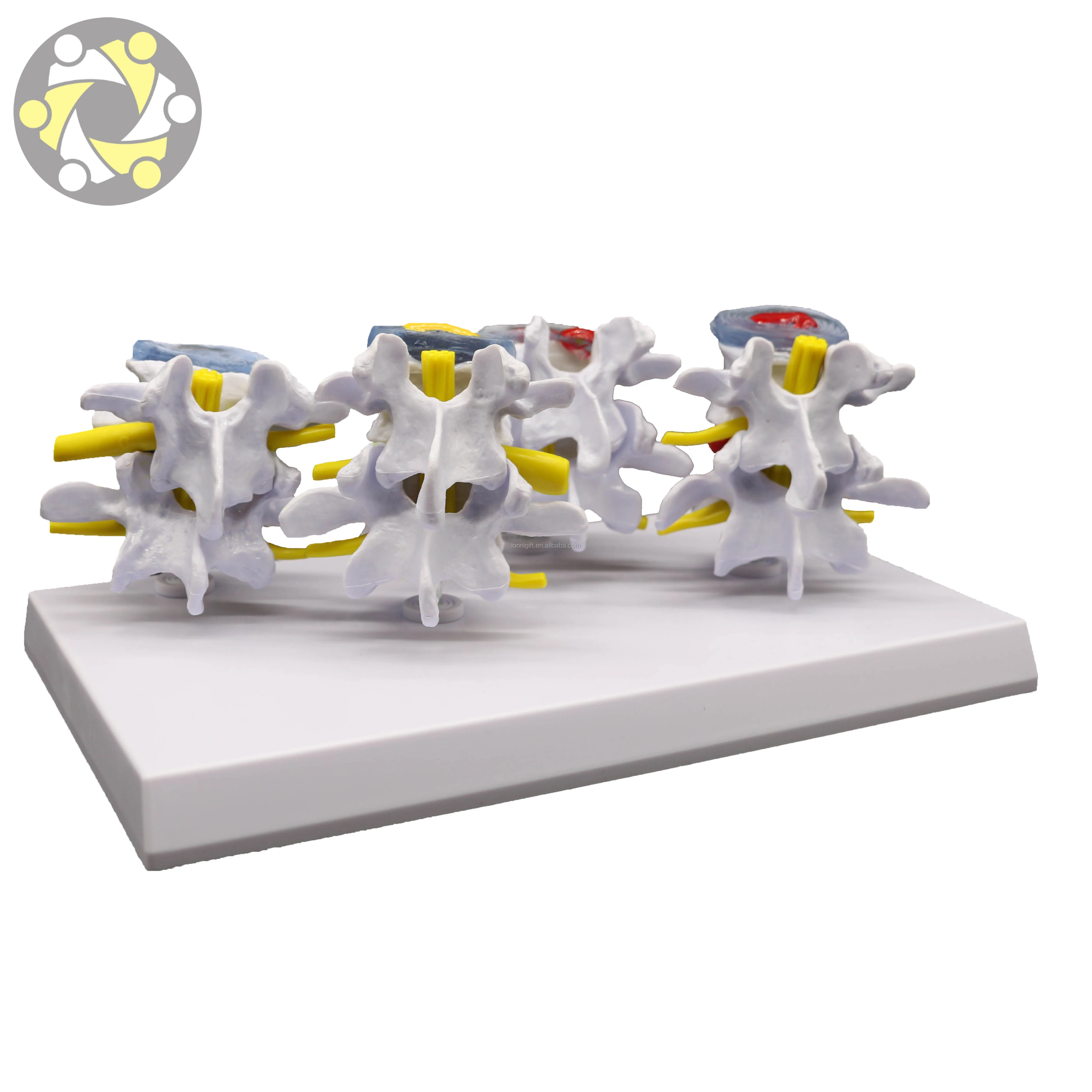 Medical Science 4 Stage Pathological Lumbar Skeleton Model