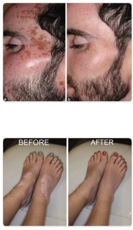 
Treatment of vitiligo Raw material and benoquin cream Pure monobenzone 99%/ Monobenzone Whitening Cream 40%-60% 