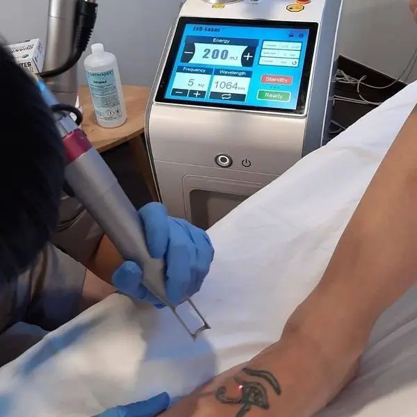 2023 q switched nd yag laser tattoo removal machine q switch laser with South Korea imported light guide arm