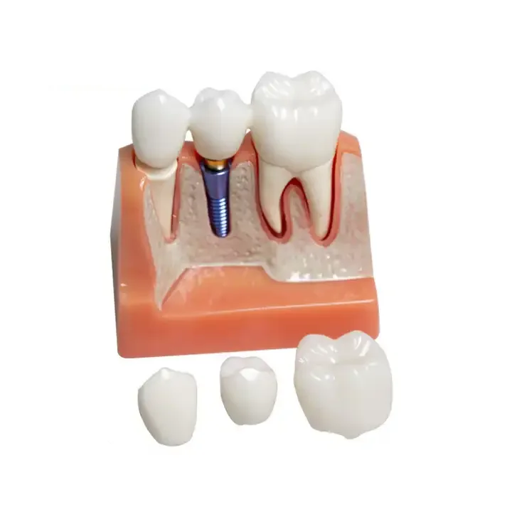 Dental Implant Model for Patient Demonstration Dental Implant Crown and Bridge Model