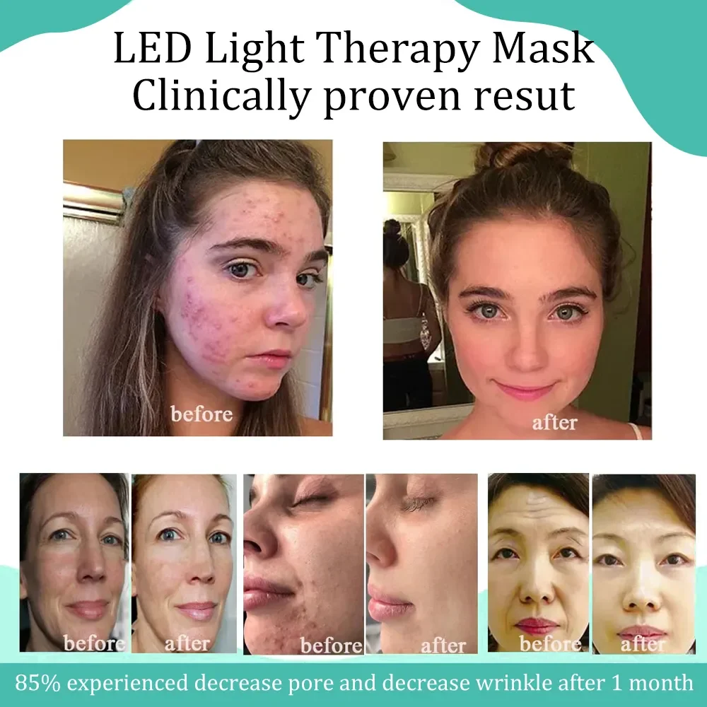 SEMS Rf Lifting Multifunction Microcurrent Facial Toning Collagen Booster High Radio Frequency Home Use Beauty Device