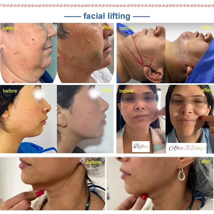 Facelift 1470nm machine endolaser facial laser lifting skin tighten