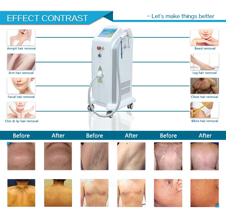 Most powerful diode laser hair removal system 755 808 1064 nm for dark skin TEC cooling system with free training