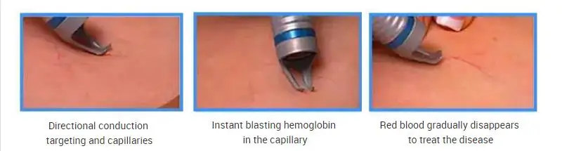 980 laser treatment.jpg