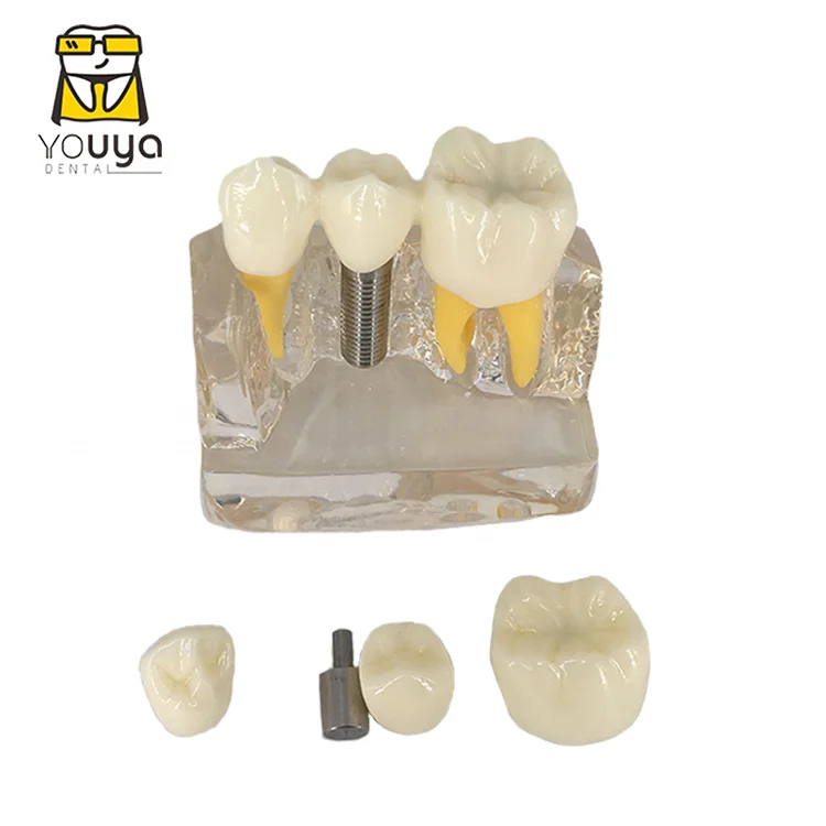 Dental Implant 4 Times Removable Teeth Model For Dental Clinic