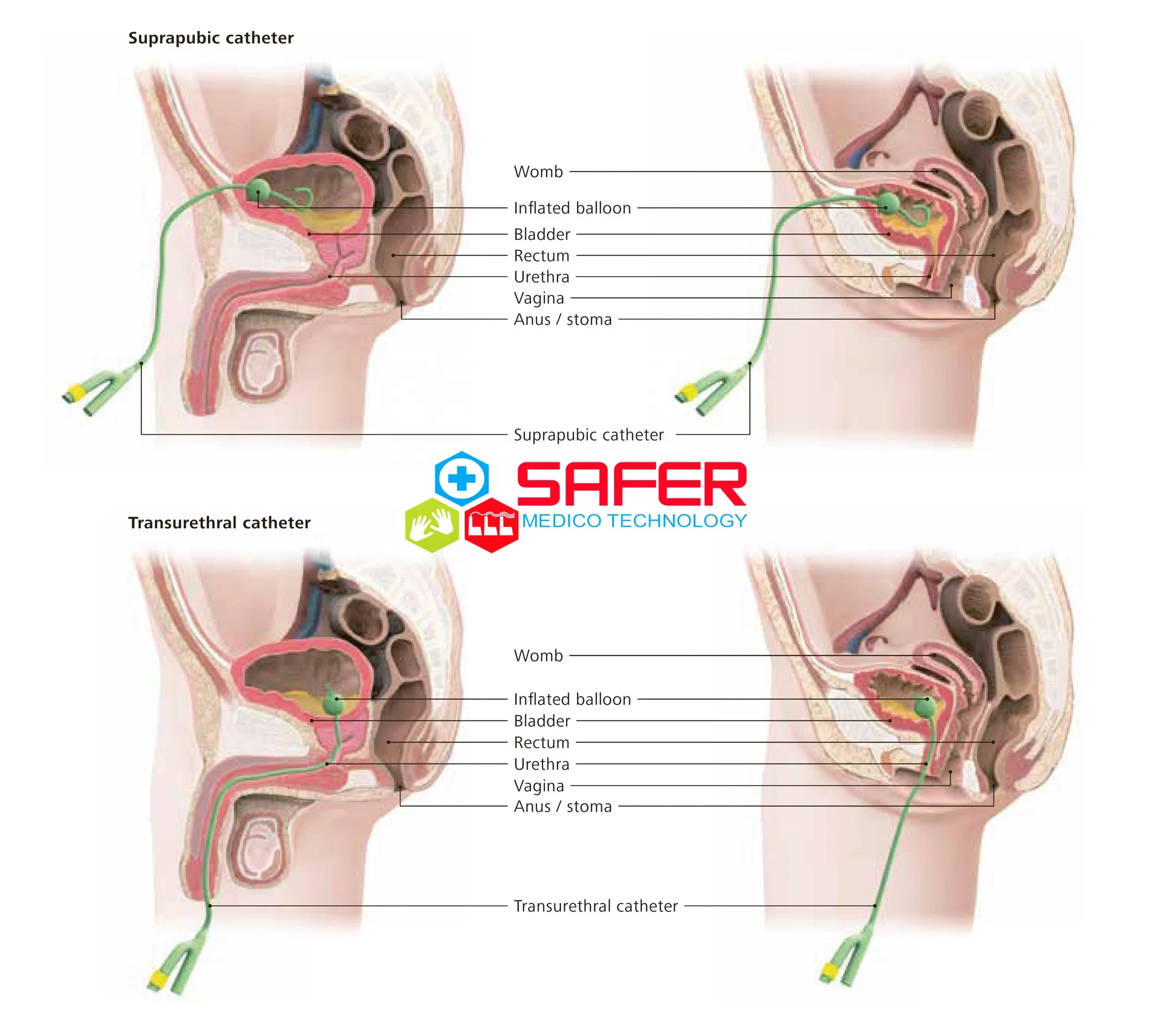 Foley Balloon Catheter