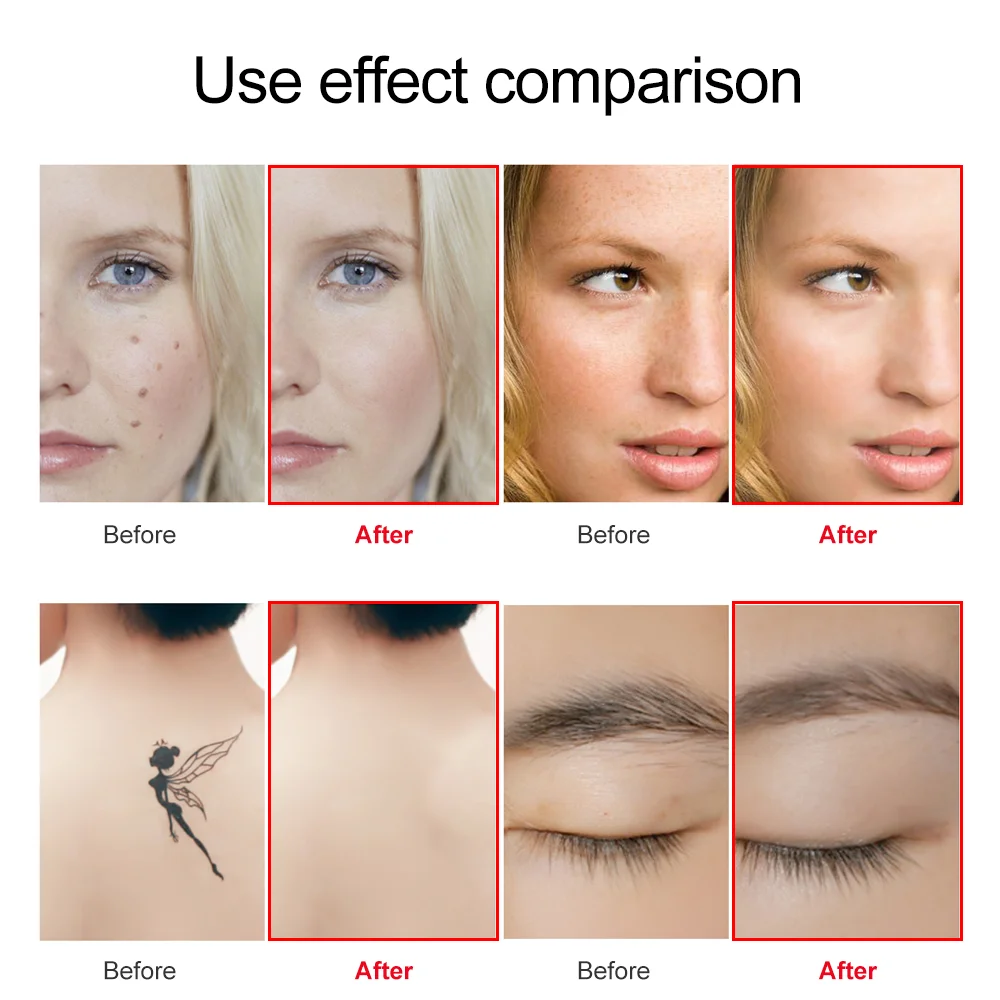 Good price of New product handheld Plasma pen freckle remove mole spot removal multi-function laser spot removal pen