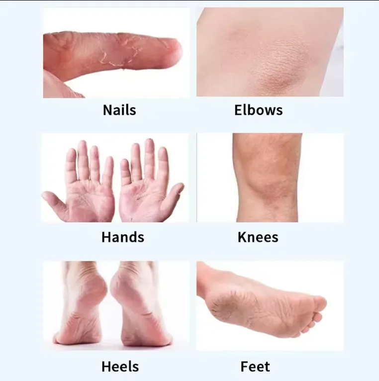 2% salicylic Acid Dead skin removal exfoliating treatment for cracked heels urea 40% foot cream hand and foot cream