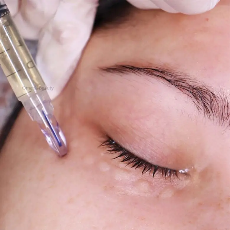 Nanosoft Fillmed-Microagujas, Aguja Nanosoft 3Pin 34G 0,6Mm Antienvejecimiento Alrededor De Ojos Y Cuello