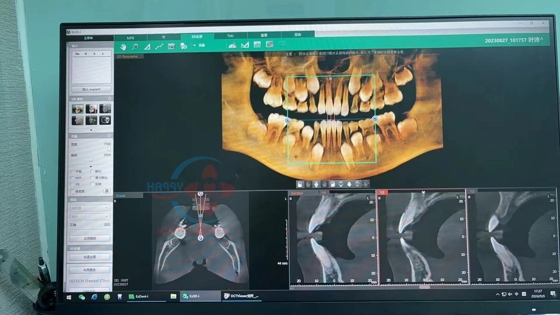 Стоматологический рентгеновский аппарат cbct стоматологический opg PHT-35LHS поля зрения 12*9 см высокочастотный