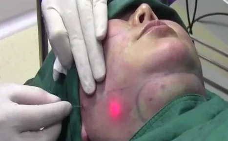 Dual wavelength diode laser 980+1470nm liposuction fat dissolution clinic use