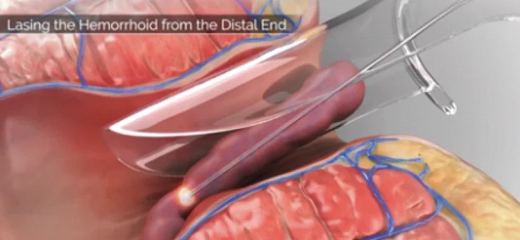 980nm Hemorrhoids Laser Surgical Equipment