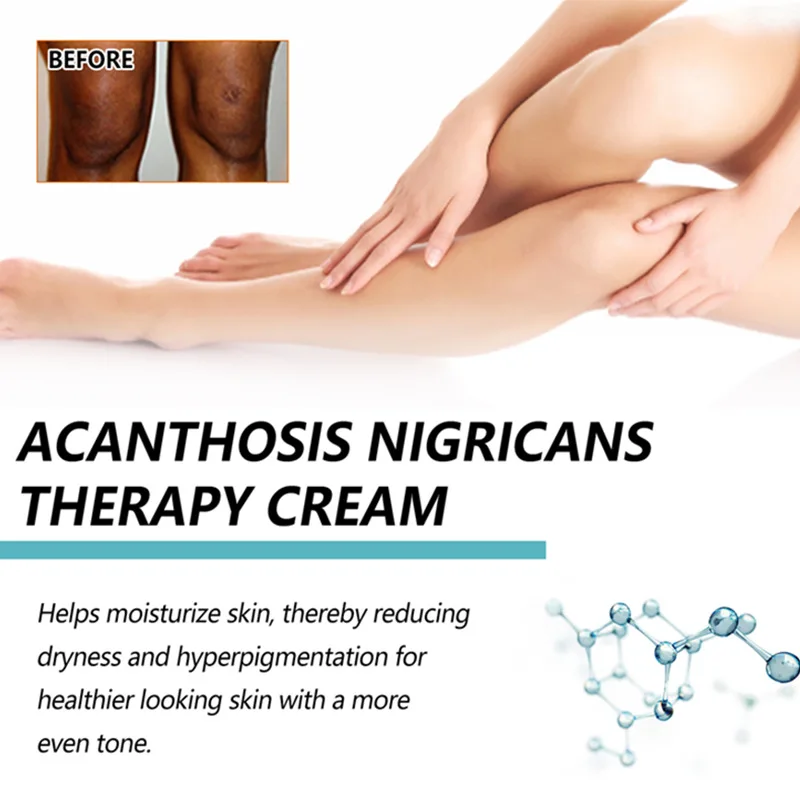 EELHOE 50g acanthosis nigricans therapy cream nape elbow knees knuckles back moisturizing brightening exfoliating cream